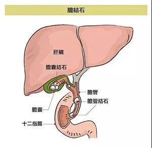 冬季膽結(jié)石“兇猛” 小石頭危害大！